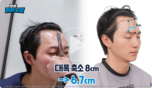 모모 수술상담 썸네일3